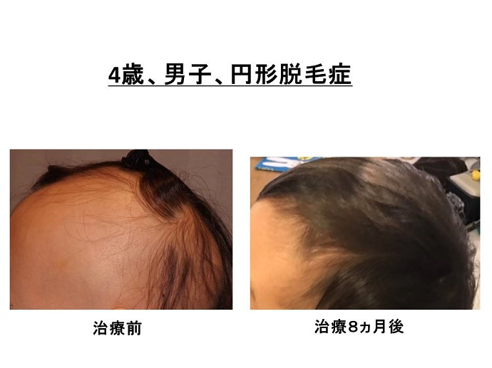 円形脱毛症　病院""